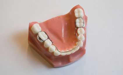 Ling Hold Arch B 8119(lingualinvisible) - Bronsky Orthodontics NYC