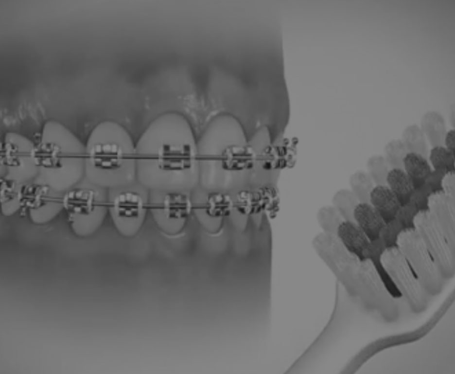 Brushing Techniques with a Proxabrush for Braces