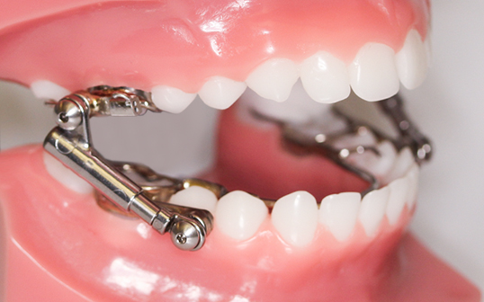 All About the Fixed Functional Appliance or “Herbst” Appliance - Bronsky  Orthodontics NYC