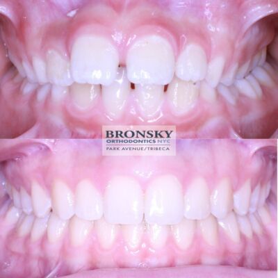 Lingual Braces - Bronsky Orthodontics NYC